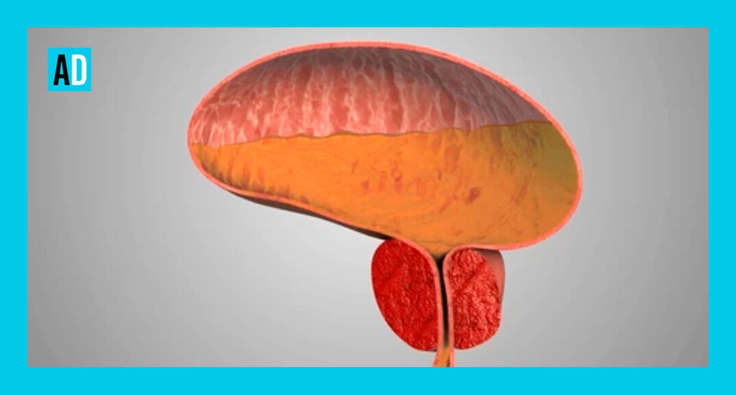 Prostată inflamată